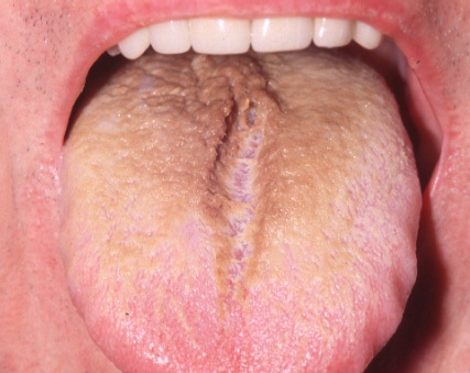 oral thrush symptoms #11