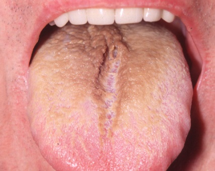 Thrush (Oral Candidiasis) Symptoms, Treatment, Causes ...