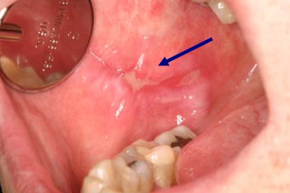 Signs and Symptoms - Mouth Cancer Action Month