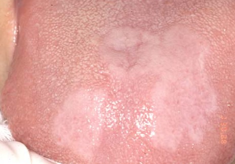 Lichen Planus Causes, Treatment, and Symptoms