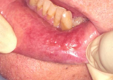 Oral Lichen Planus - Mouth Ulcers