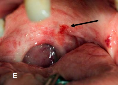 Pictures Of Red Spots On Palate 112