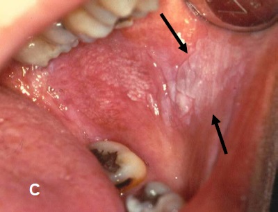 White Lesion In Mouth 11