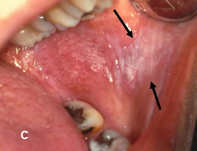 Lesion In The Mouth 36