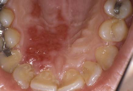 Shingles Of The Mouth 52