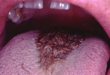 Treatment for Black Hairy Tongue  Dimensions of Dental Hygiene