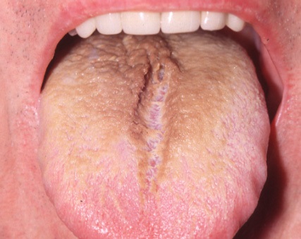 Black Hairy Tongue: Causes, Symptoms And Treatment