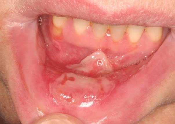 Image result for Oral Mucositis