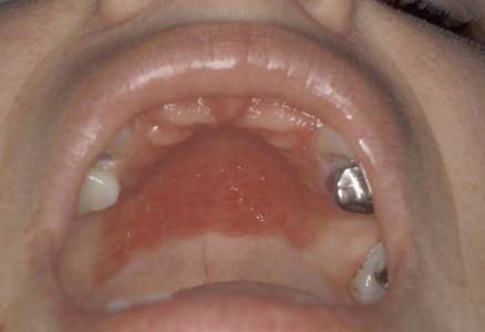 Oral Yeast Infections