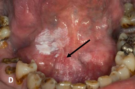 Premalignant Oral Lesions